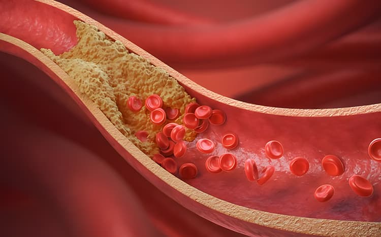 Enfermedad arterial coronaria