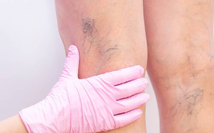 Enfermedad vascular periférica